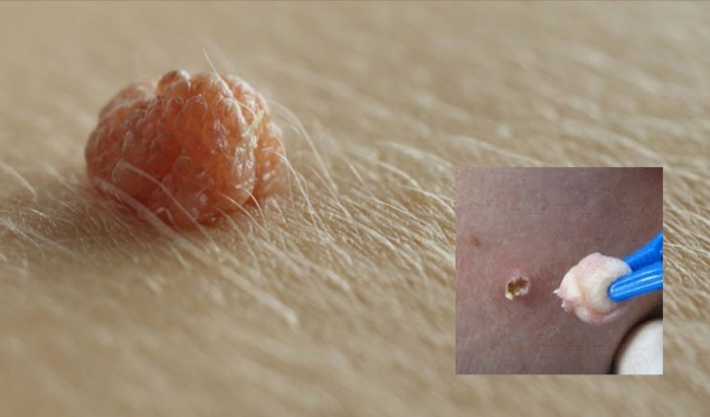 Mụn thịt thừa - Hình ảnh minh họa