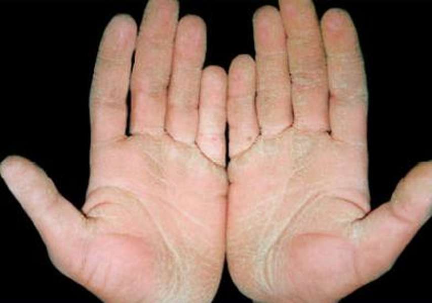 Actinic Keratosis - Hình ảnh minh họa