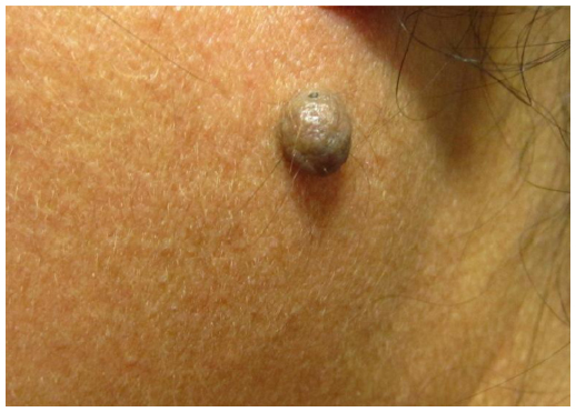 Melanocytic Naevi - Hình ảnh minh họa