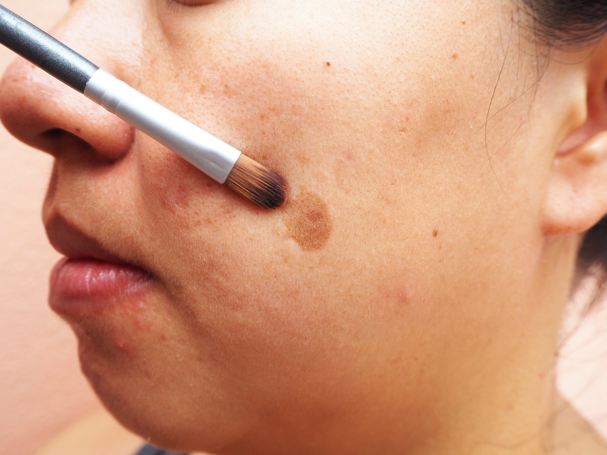 Melasma - Hình ảnh minh họa