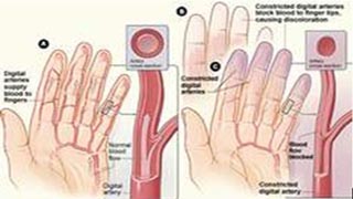 Múa giật Sydenham - Hình ảnh minh họa