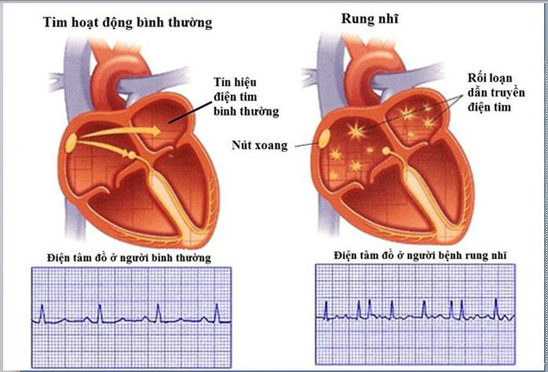 Atrial Fibrillation - Hình ảnh minh họa