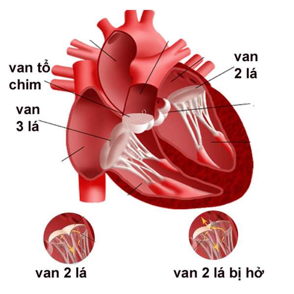 Aortic Valvular Regurgitation - Hình ảnh minh họa
