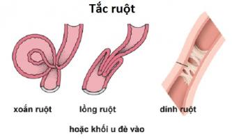 Nghẽn ruột - Hình ảnh minh họa