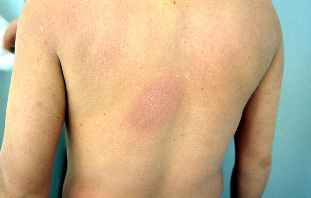 Nấm Mycosis Fungoides - Hình ảnh minh họa