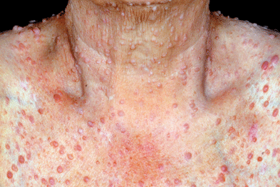 Neurofibromatosis - Hình ảnh minh họa