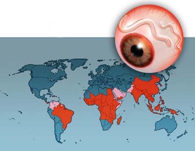 Mù lòa do giun chỉ Onchocerca - Hình ảnh minh họa