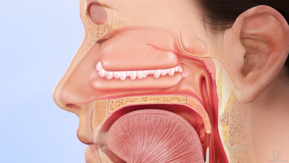 Nasal polyps - Hình ảnh minh họa
