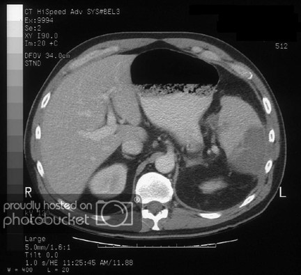 Nhồi máu lá lách - Hình ảnh minh họa