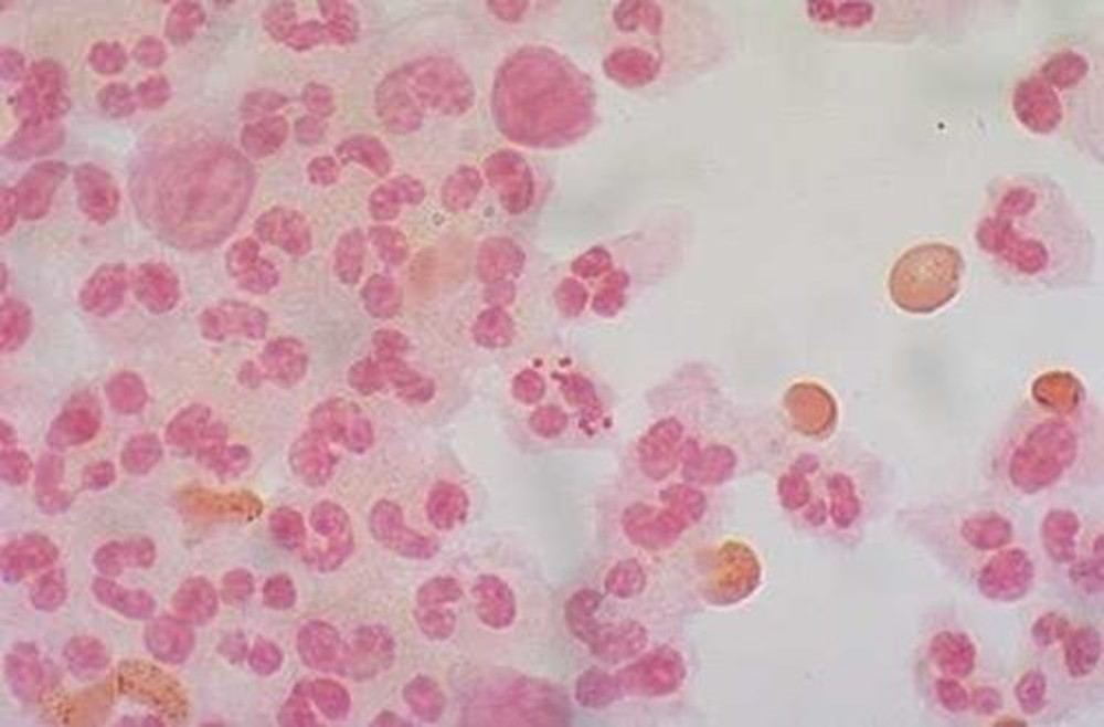 Màng não cầu - Hình ảnh minh họa