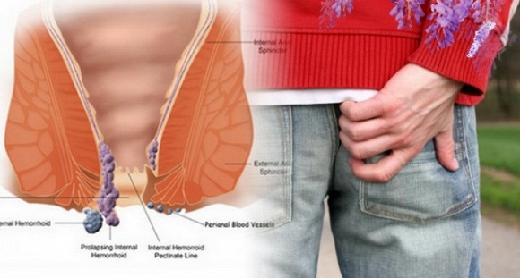 Ngứa hậu môn - Hình ảnh minh họa