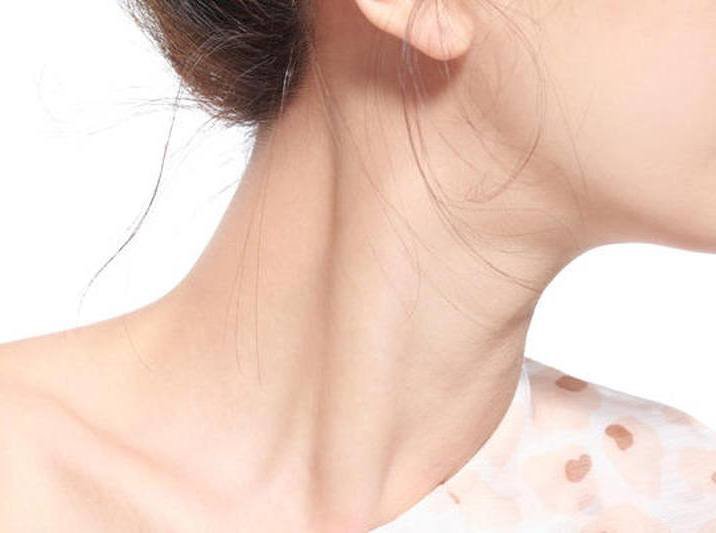 Nổi hạch cổ - Hình ảnh minh họa