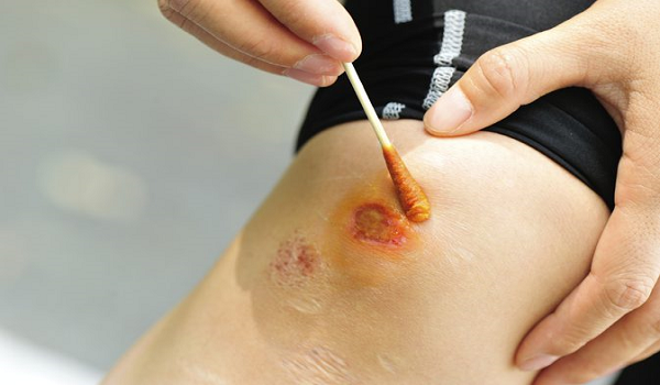 Nhiễm trùng vết thương - Hình ảnh minh họa