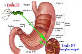 Nhiễm H. pylori (HP) - Hình ảnh minh họa