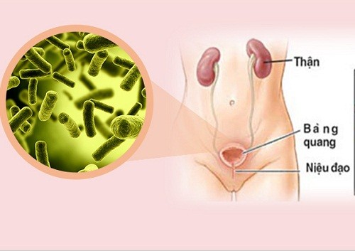 Nhiễm trùng tiết niệu - Hình ảnh minh họa