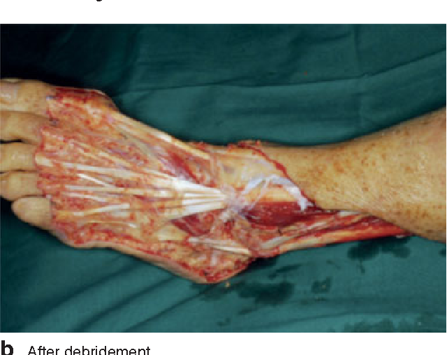 Necrotizing Fasciitis - Hình ảnh minh họa