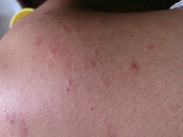 Nổi mẩn ngứa - Hình ảnh minh họa