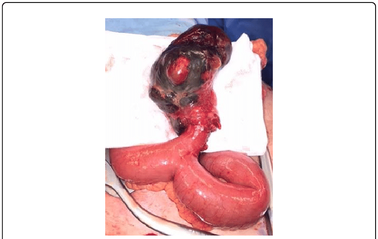 Meckel\'s Diverticulum - Hình ảnh minh họa