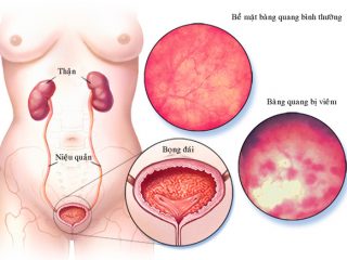 Nhiễm trùng bàng quang - Hình ảnh minh họa