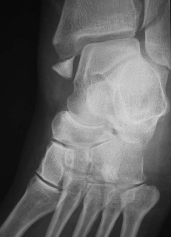 Avulsion Injuries - Hình ảnh minh họa