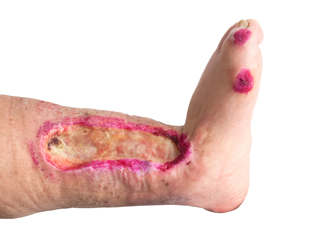 Nhiễm khuẩn Klebsiella - Hình ảnh minh họa