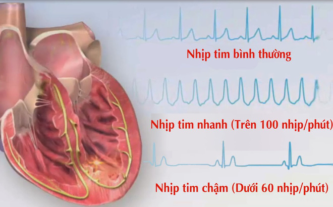 Arrhythmia Palpitations - Hình ảnh minh họa