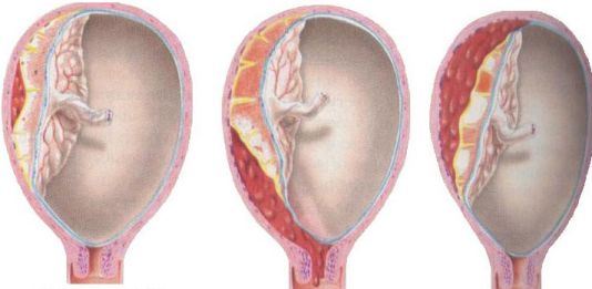 Abruptio Placentae - Hình ảnh minh họa