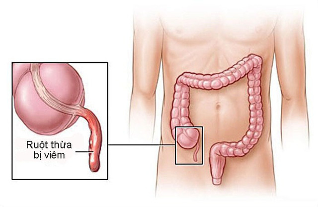 Acute appendicitis - Hình ảnh minh họa