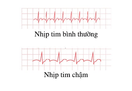 Nhịp tim chậm - Hình ảnh minh họa