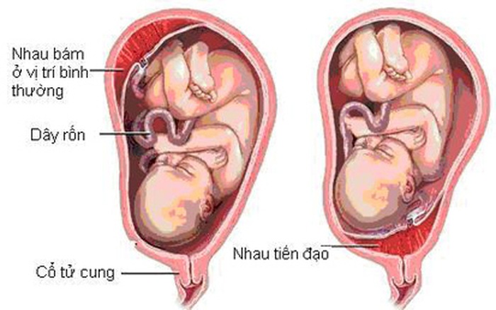 Nhau tiền đạo - Hình ảnh minh họa