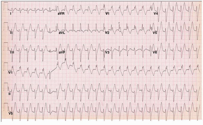 Nhịp nhanh thất - Hình ảnh minh họa