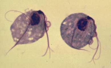 Nhiễm trùng roi sinh dục nữ - Hình ảnh minh họa