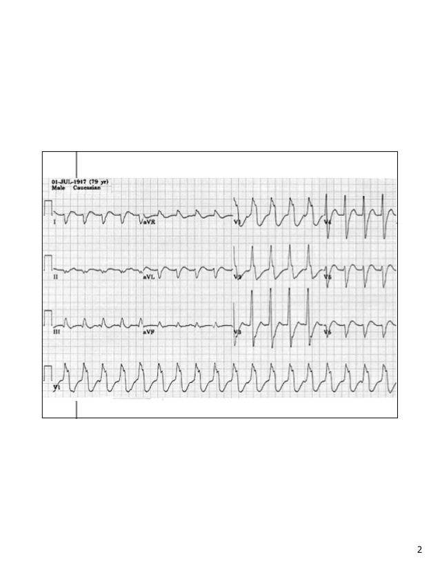 Nhịp nhanh trên thất - Hình ảnh minh họa