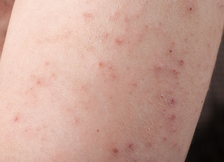 Nhiễm trùng do vi khuẩn - Hình ảnh minh họa