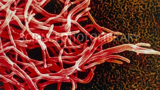 Nhiễm vi khuẩn Nocardia - Hình ảnh minh họa