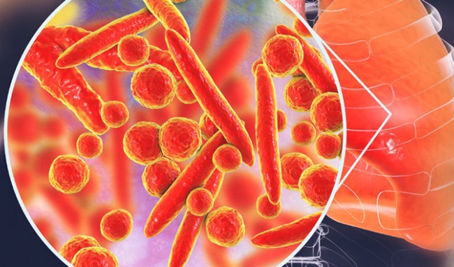 Nhiễm khuẩn Mycoplasma - Hình ảnh minh họa