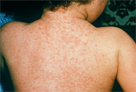 Nhiệt gai - Hình ảnh minh họa