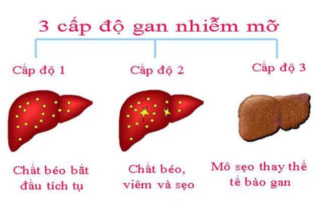 Gan nhiễm mỡ có 3 cấp độ