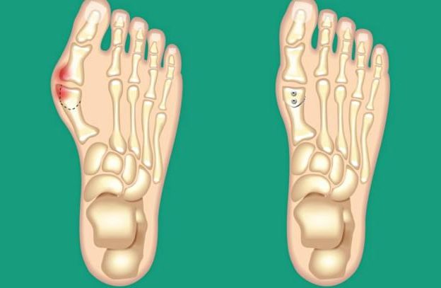 Biến dạng ngón chân cái - Hình ảnh minh họa