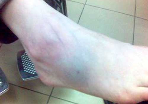 Broken bone - Hình ảnh minh họa