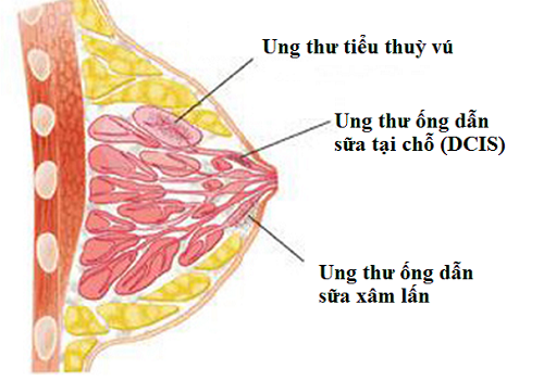 Breast cancer - Hình ảnh minh họa