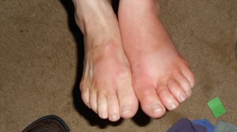 Phù chân - Hình ảnh minh họa