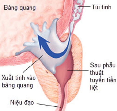 Premature ejaculation - Hình ảnh minh họa