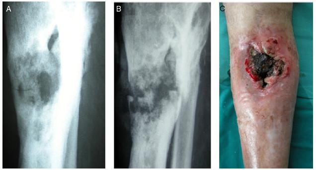 Osteomyelitis - Hình ảnh minh họa