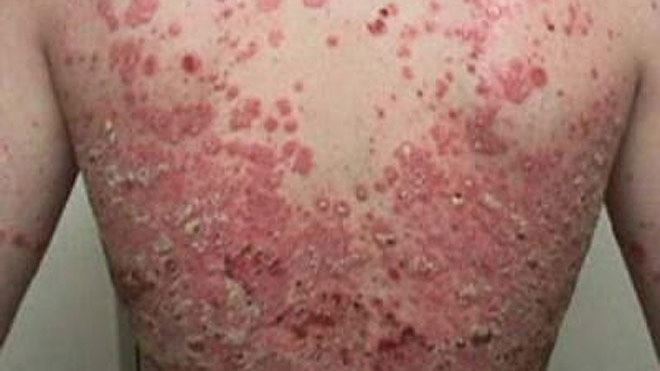 Psoriasis - Hình ảnh minh họa