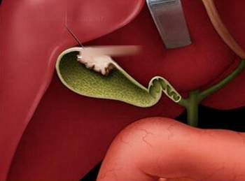 Nhiễm trùng đường mật - Hình ảnh minh họa