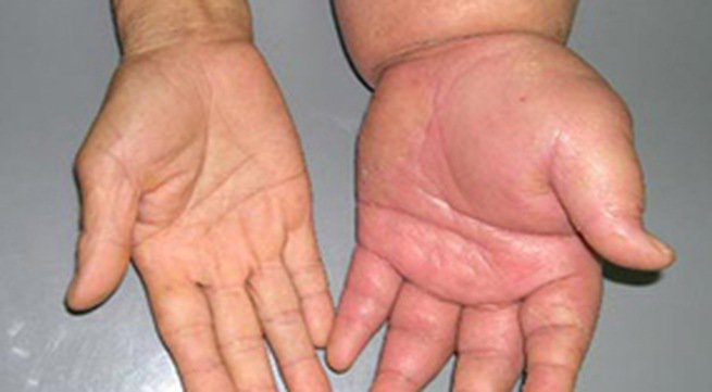 Phù tay - Hình ảnh minh họa