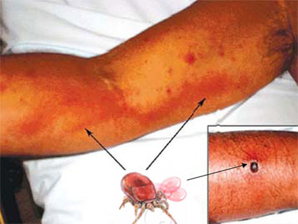 Nhiễm trùng Rickettsia - Hình ảnh minh họa