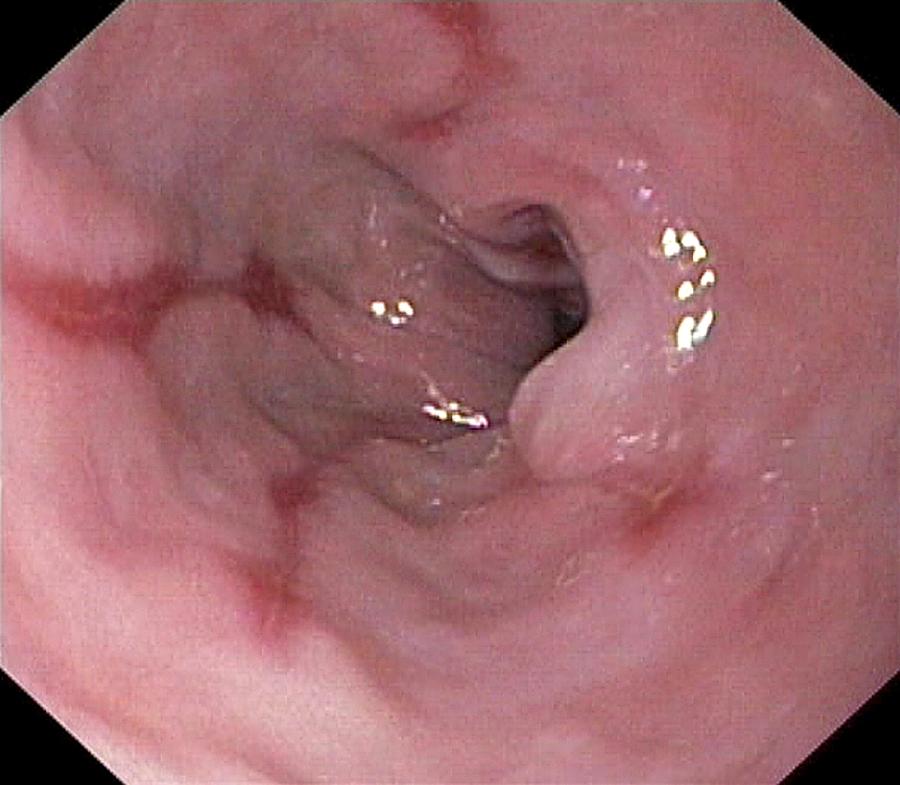 Oesophagitis - Hình ảnh minh họa
