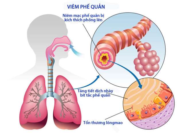 Phế quản phế viêm - Hình ảnh minh họa